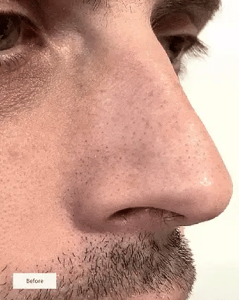 NOSE PATCHES